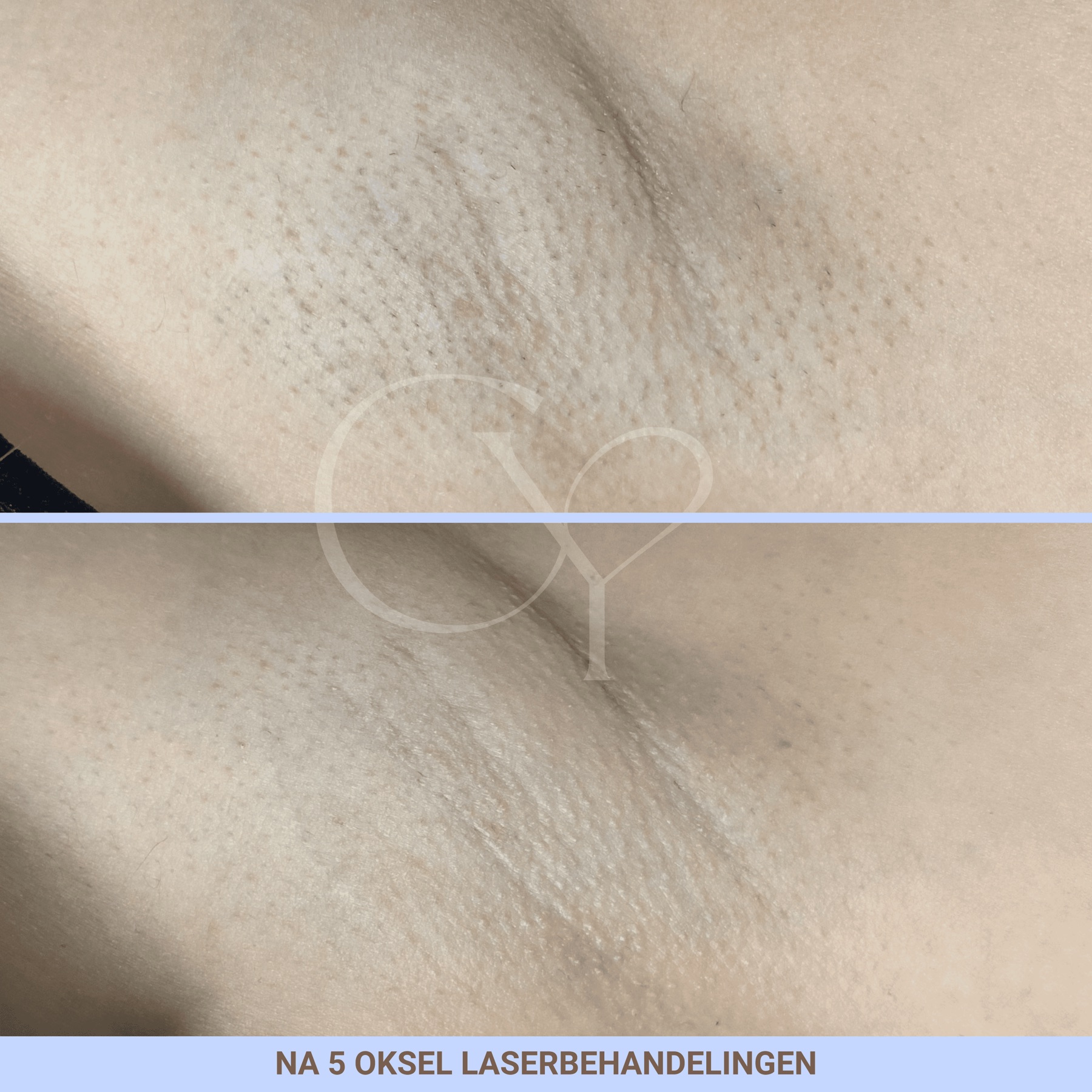 Voor en na bij Cherish Yourself: na 5 oksel laserbehandelingen