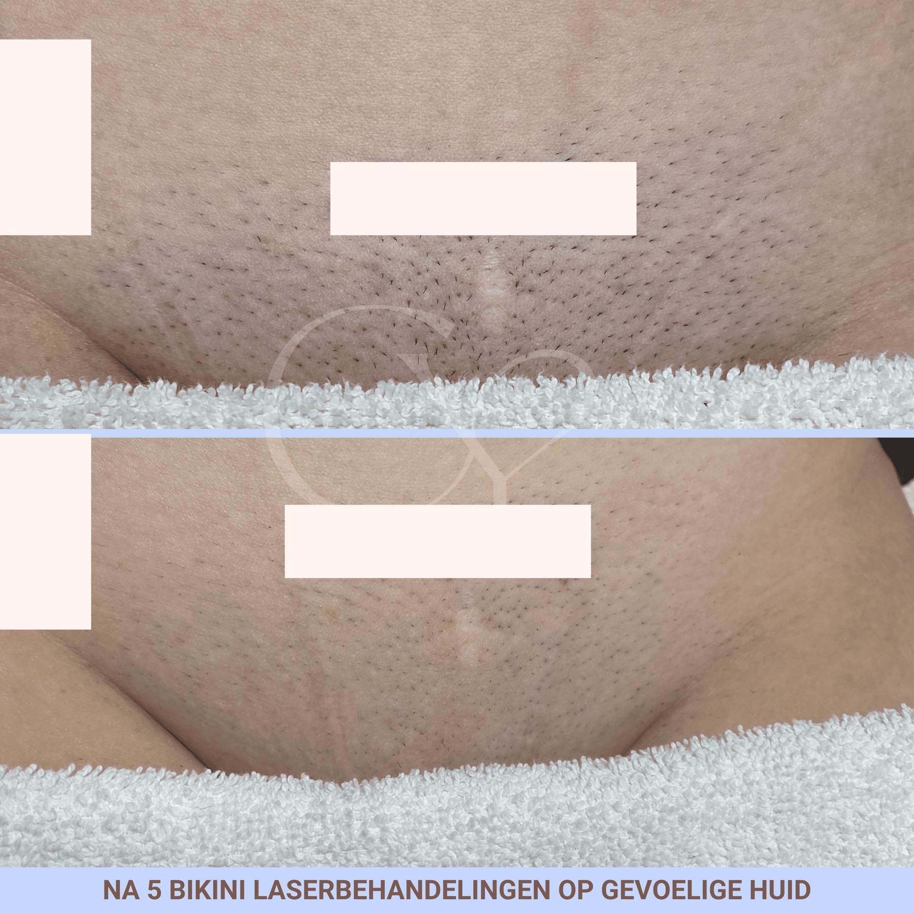 Voor en na bij Cherish Yourself: na 5 bikini laserbehandelingen op gevoelige huid