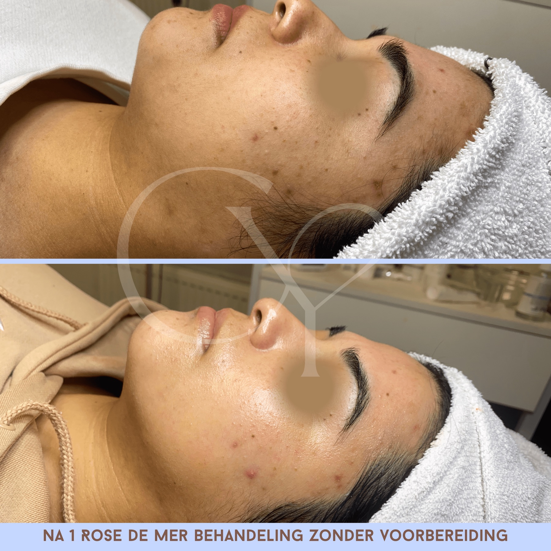 Voor en na bij Cherish Yourself: na 1 Rose de Mer behandeling zonder voorbereiding