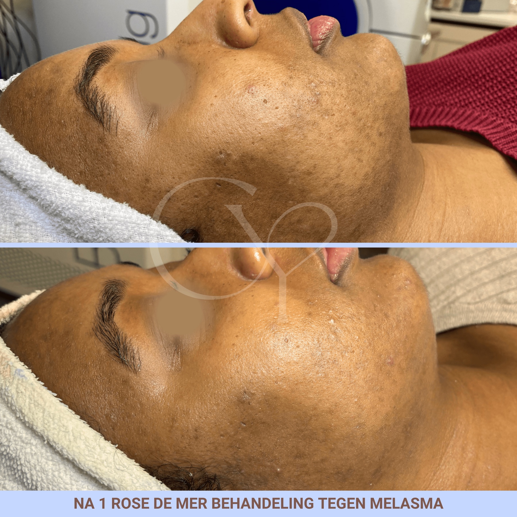 Voor en na bij Cherish Yourself: na 1 Rose de Mer behandeling tegen melasma