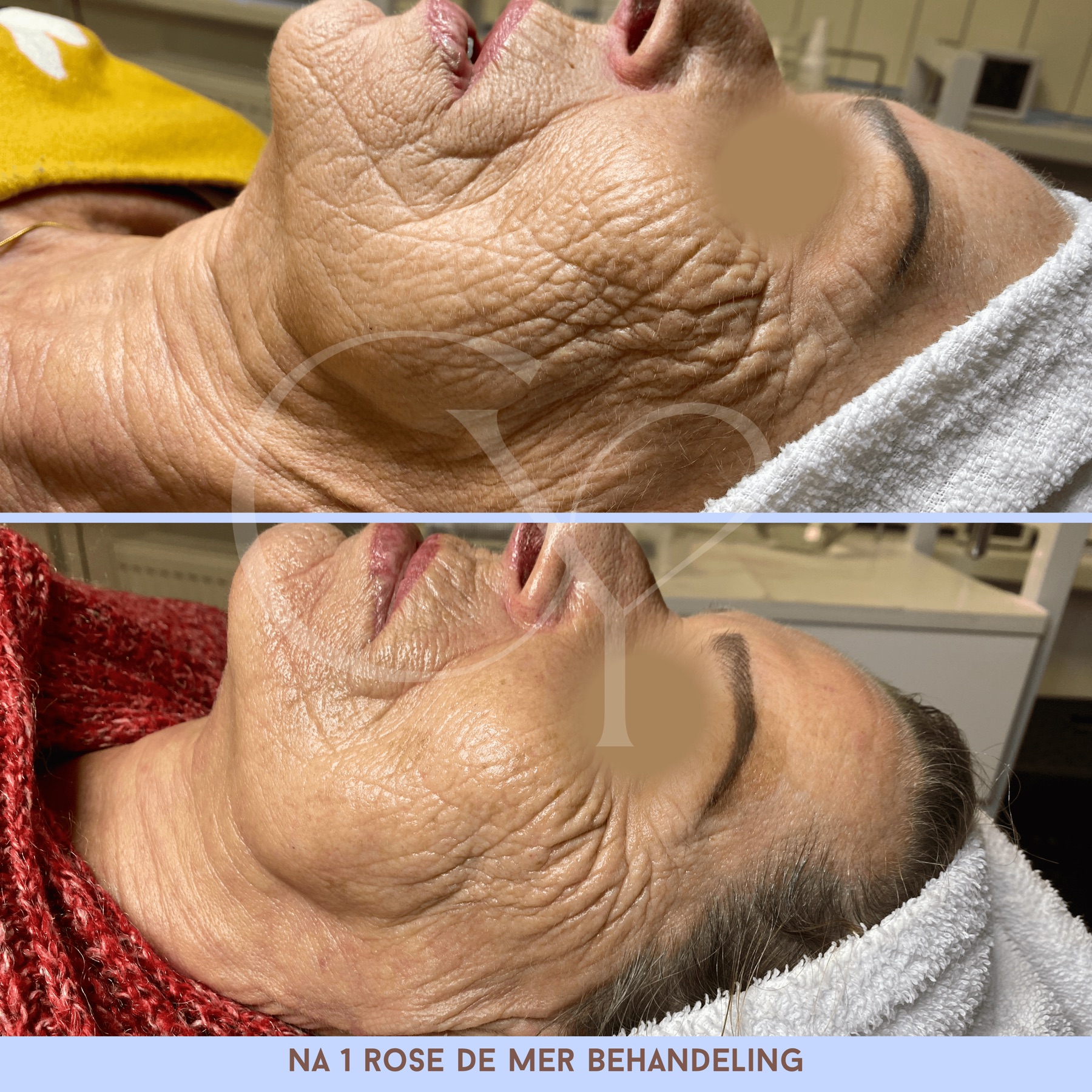 Voor en na bij Cherish Yourself: na 1 Rose de Mer behandeling
