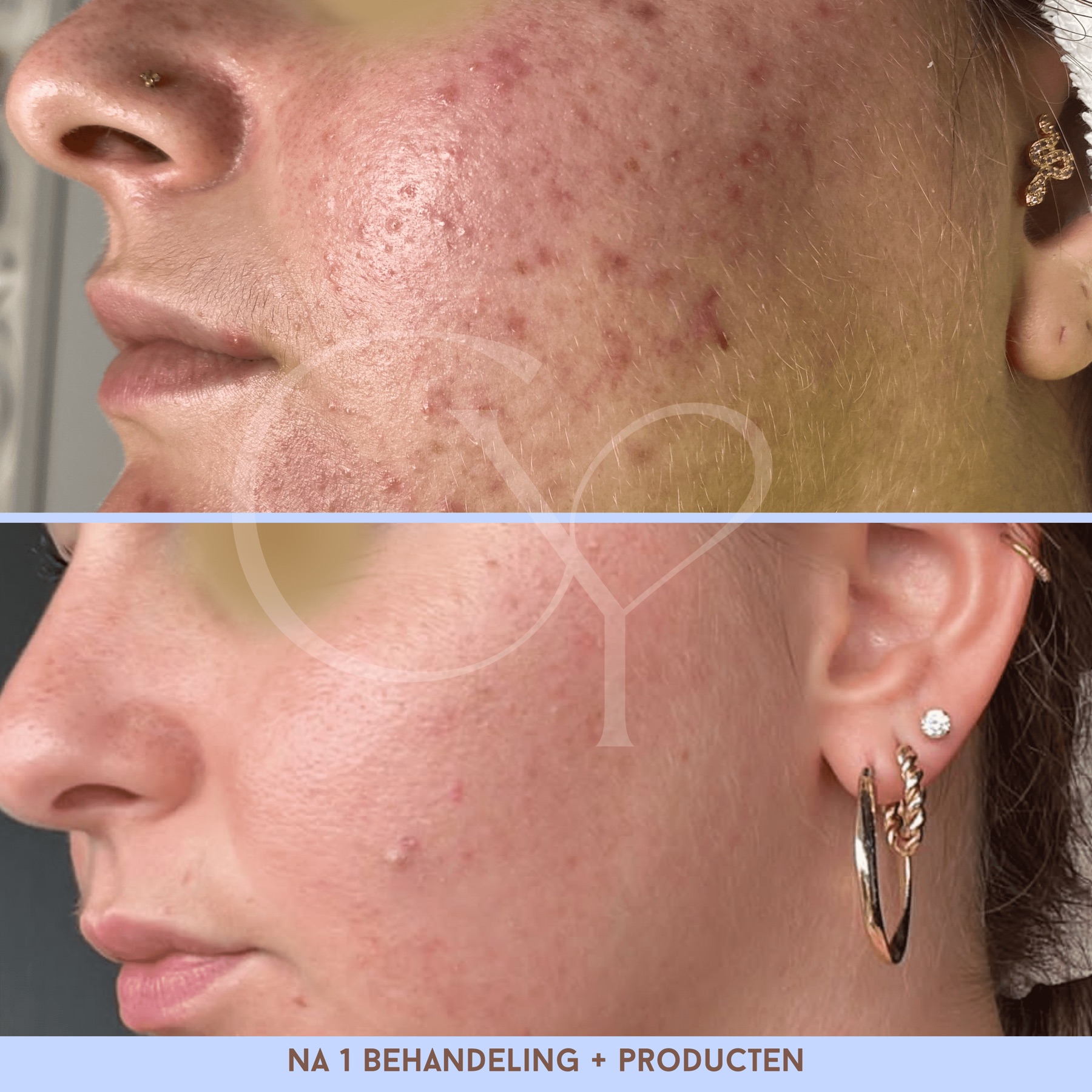 Voor en na bij Cherish Yourself: na 1 behandeling en producten