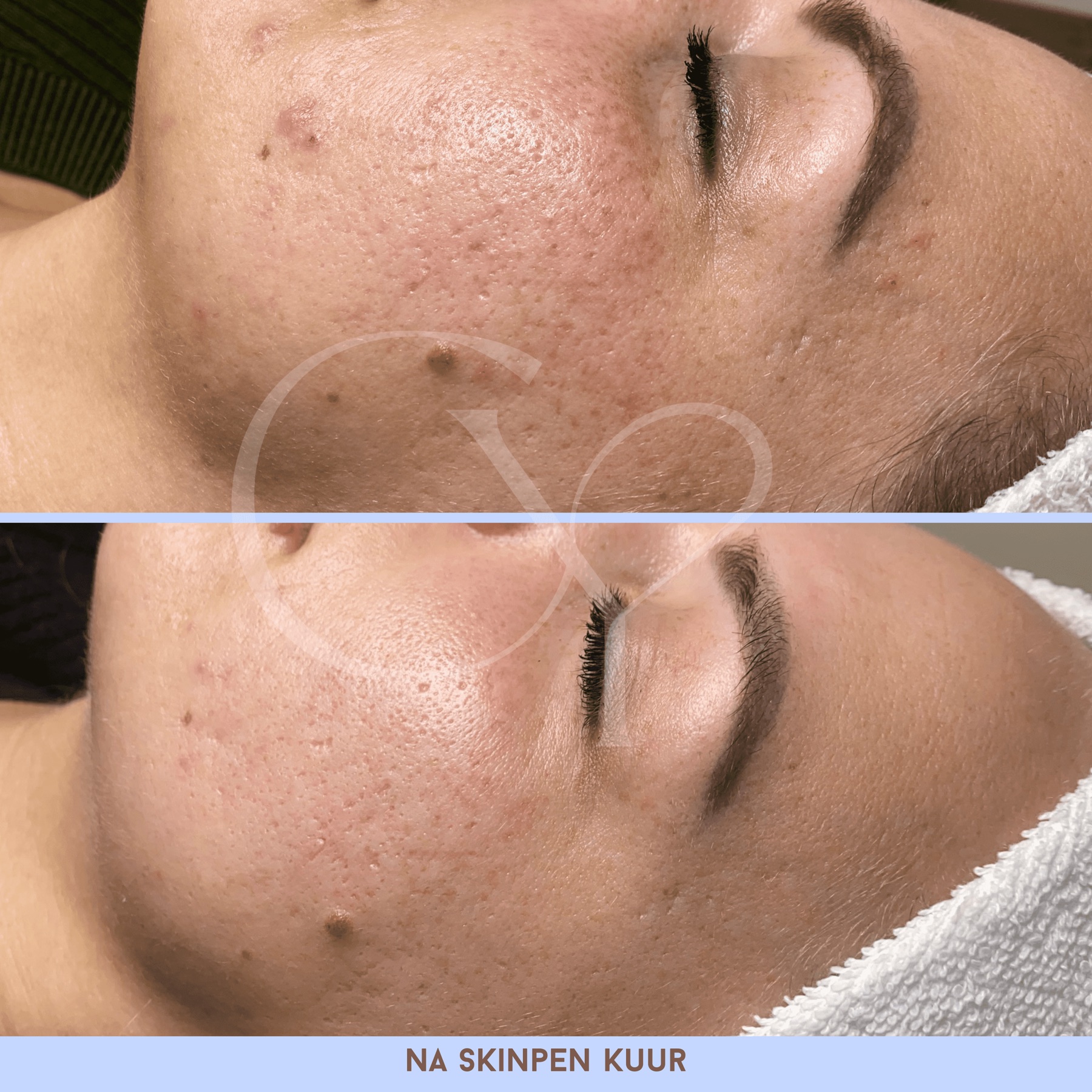 Voor en na bij Cherish Yourself: na een SkinPen kuur