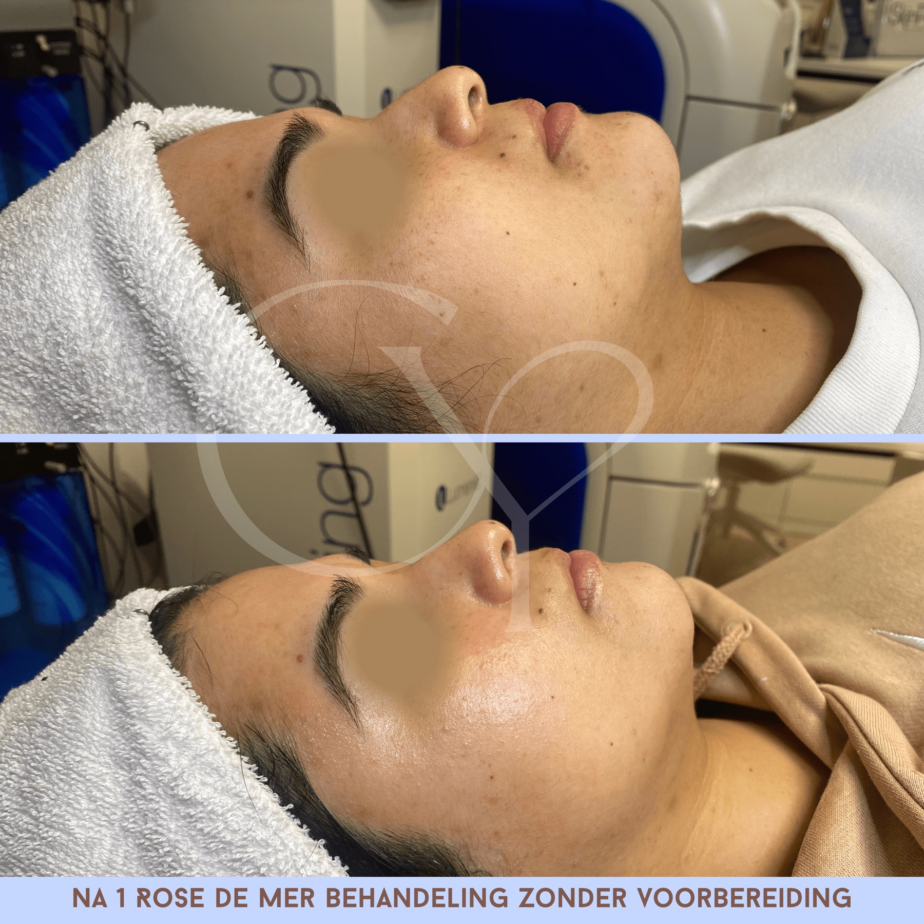 Voor en na bij Cherish Yourself: na 1 Rose de Mer behandeling zonder voorbereiding