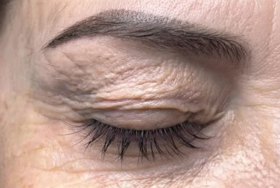 Bovenooglid voor de fibroblast behandeling