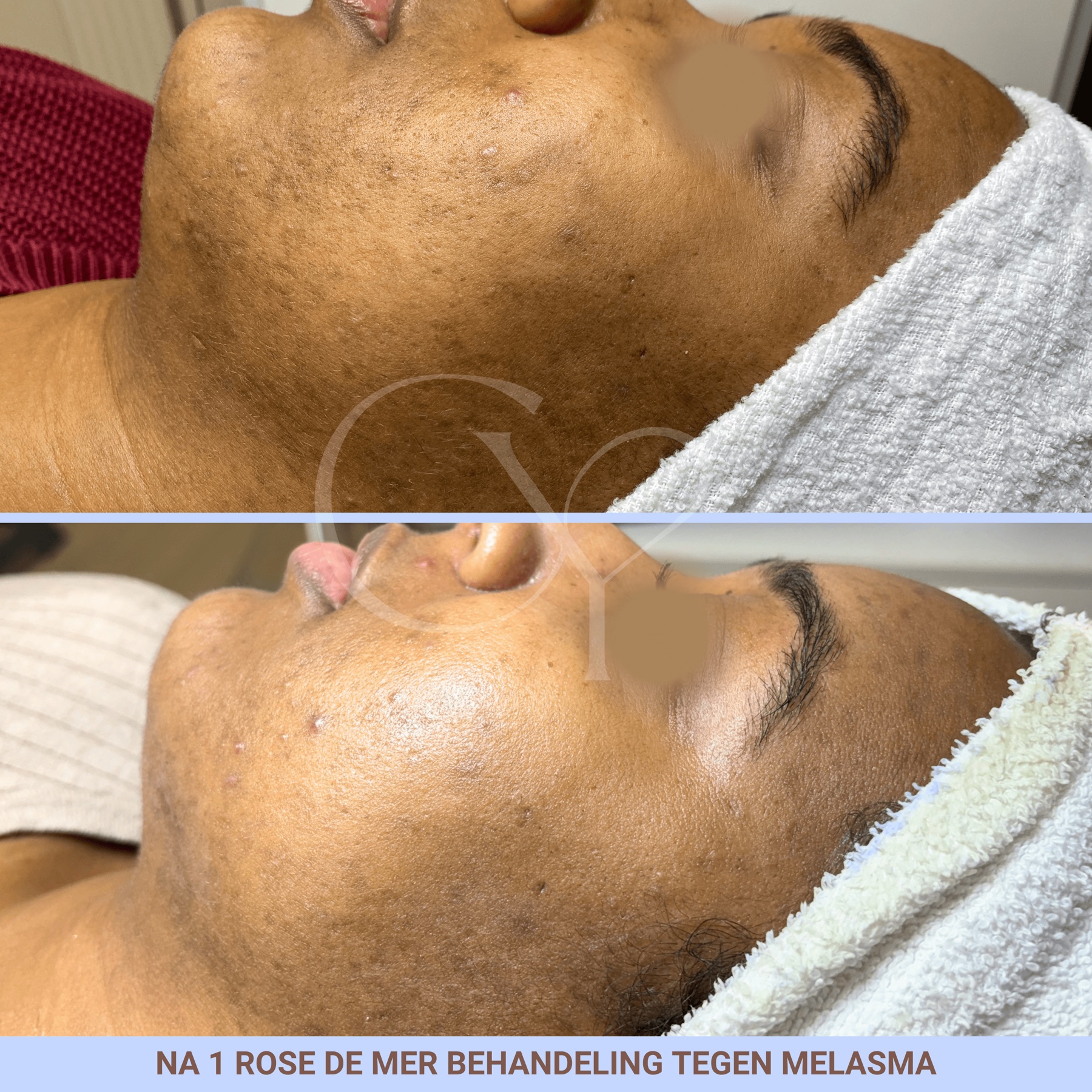 Voor en na bij Cherish Yourself: na 1 Rose de Mer behandeling tegen melasma