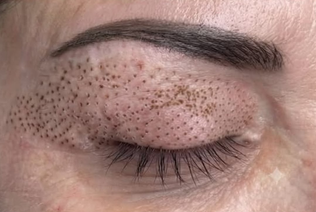 Bovenooglid vlak na de fibroblast behandeling, met kleine puntjes