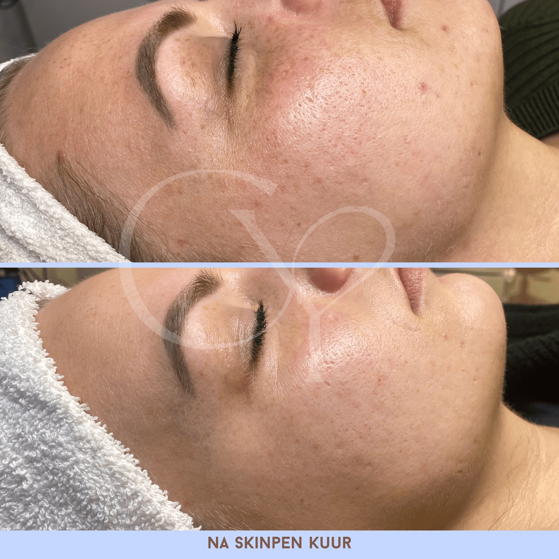 Voor en na bij Cherish Yourself: na een SkinPen kuur