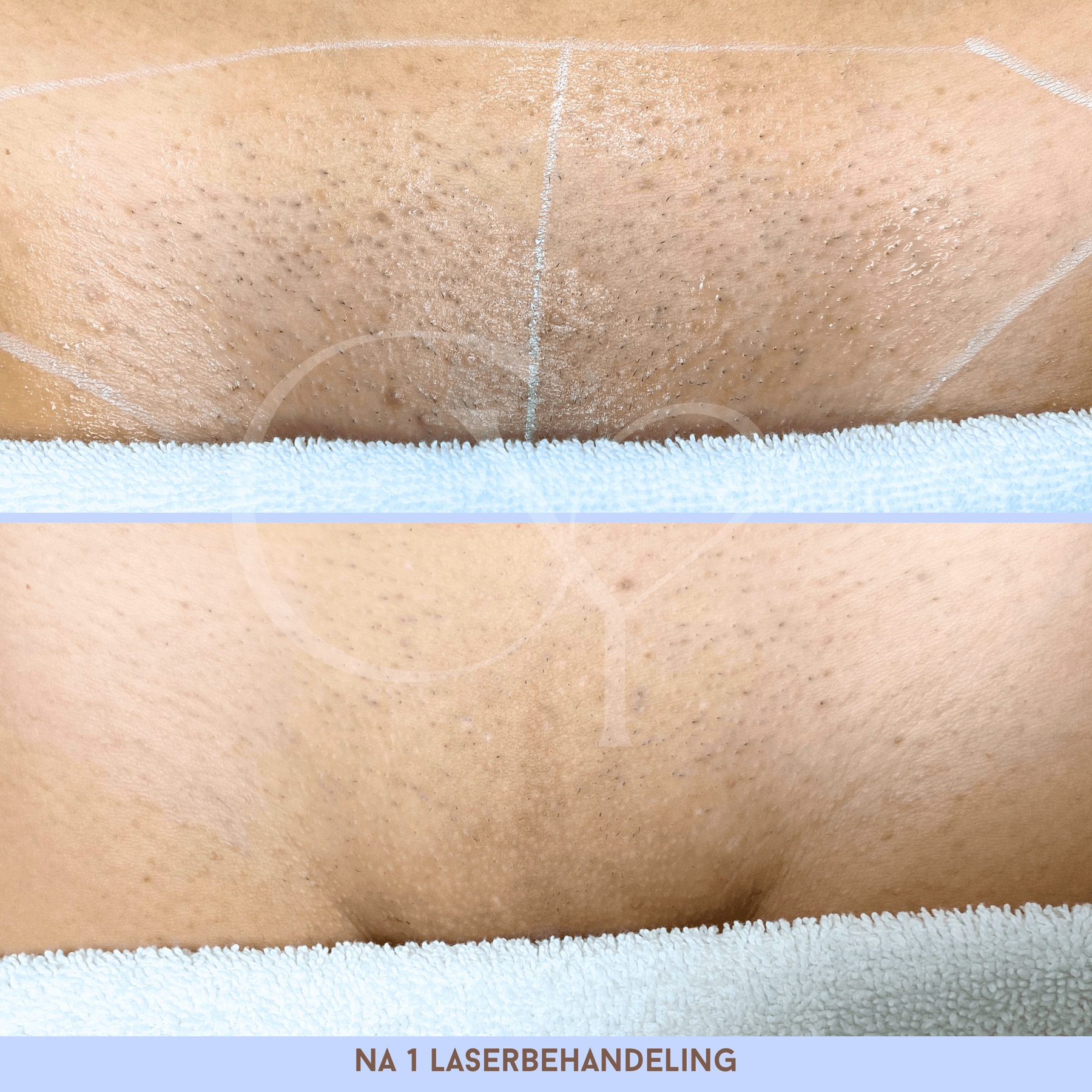 Voor en na bij Cherish Yourself: na 1 laserbehandeling