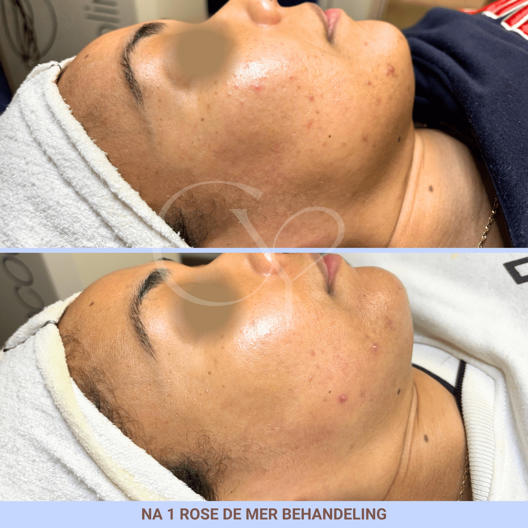Voor en na bij Cherish Yourself: na 1 Rose de Mer behandeling