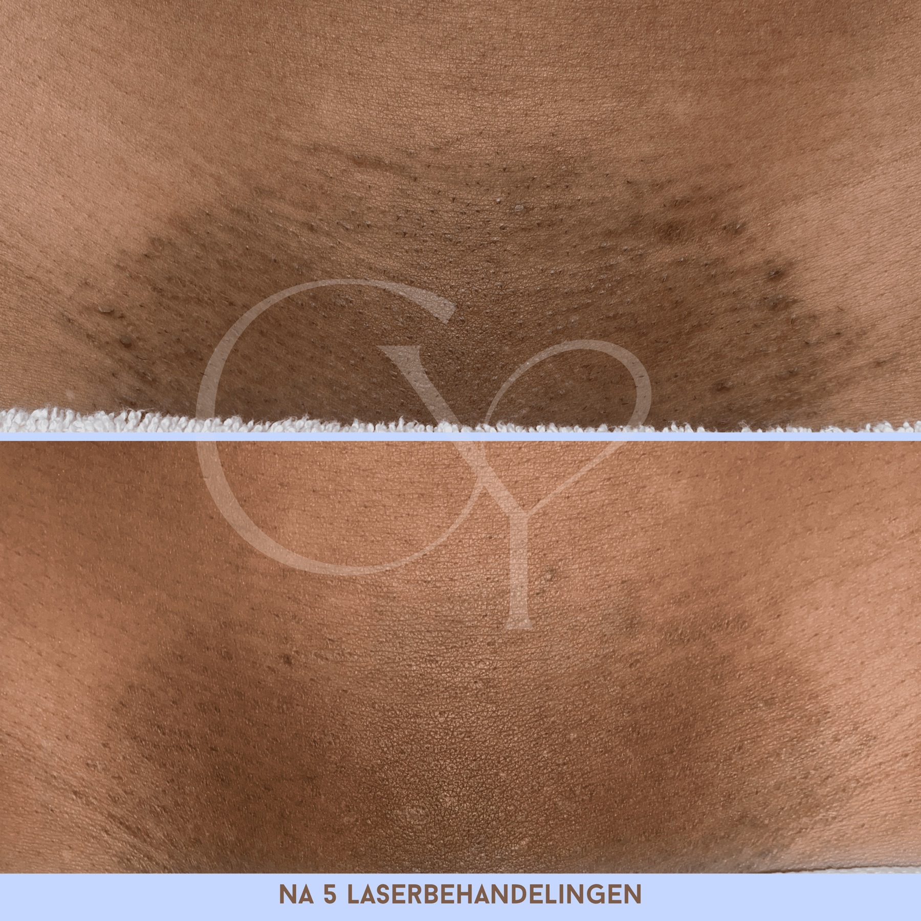 Voor en na bij Cherish Yourself: na 5 laserbehandelingen