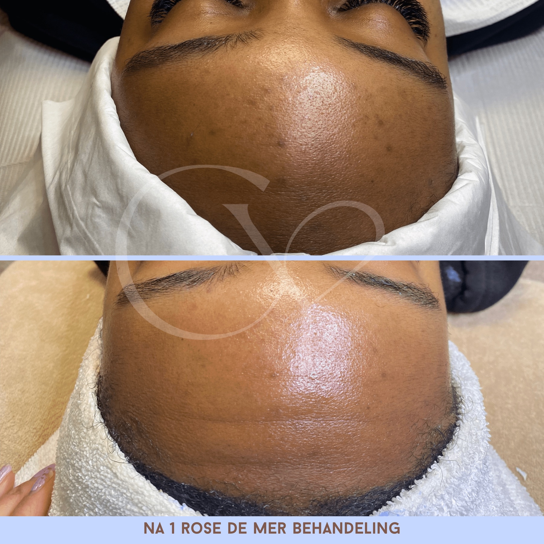 Voor en na bij Cherish Yourself: na 1 Rose de Mer behandeling