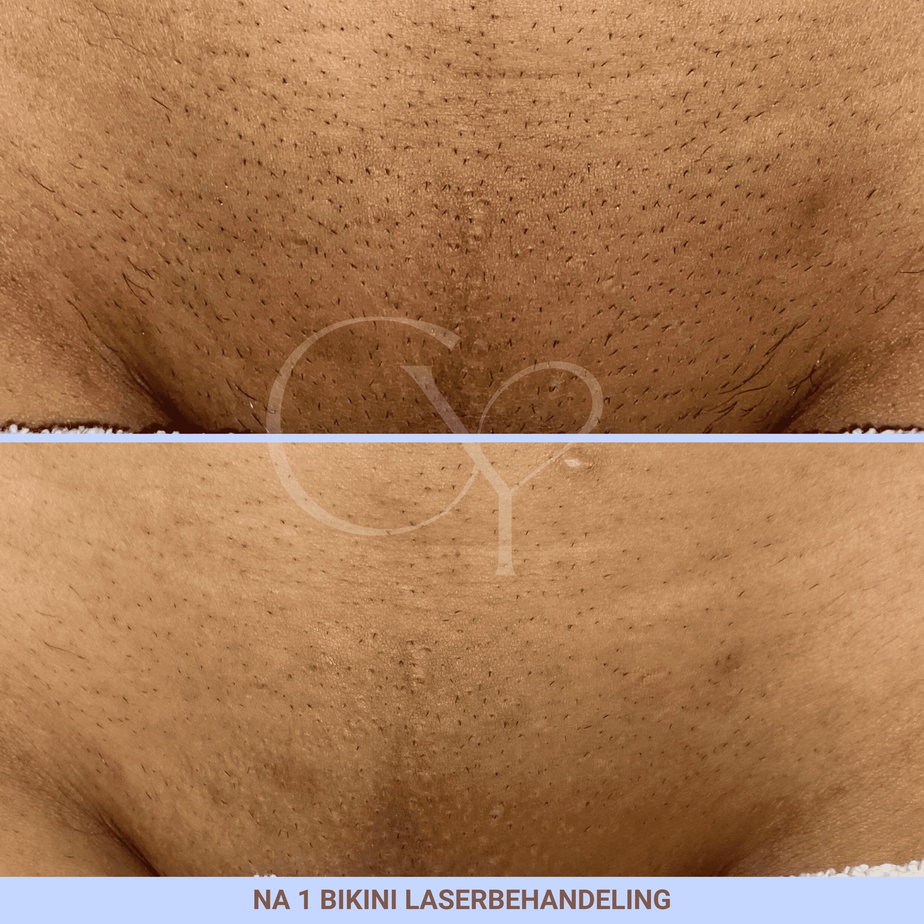 Voor en na bij Cherish Yourself: na 1 bikini laserbehandeling