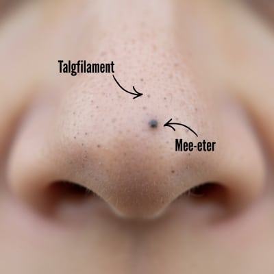 Vergelijking tussen een talgfilament en een mee-eter op de neus