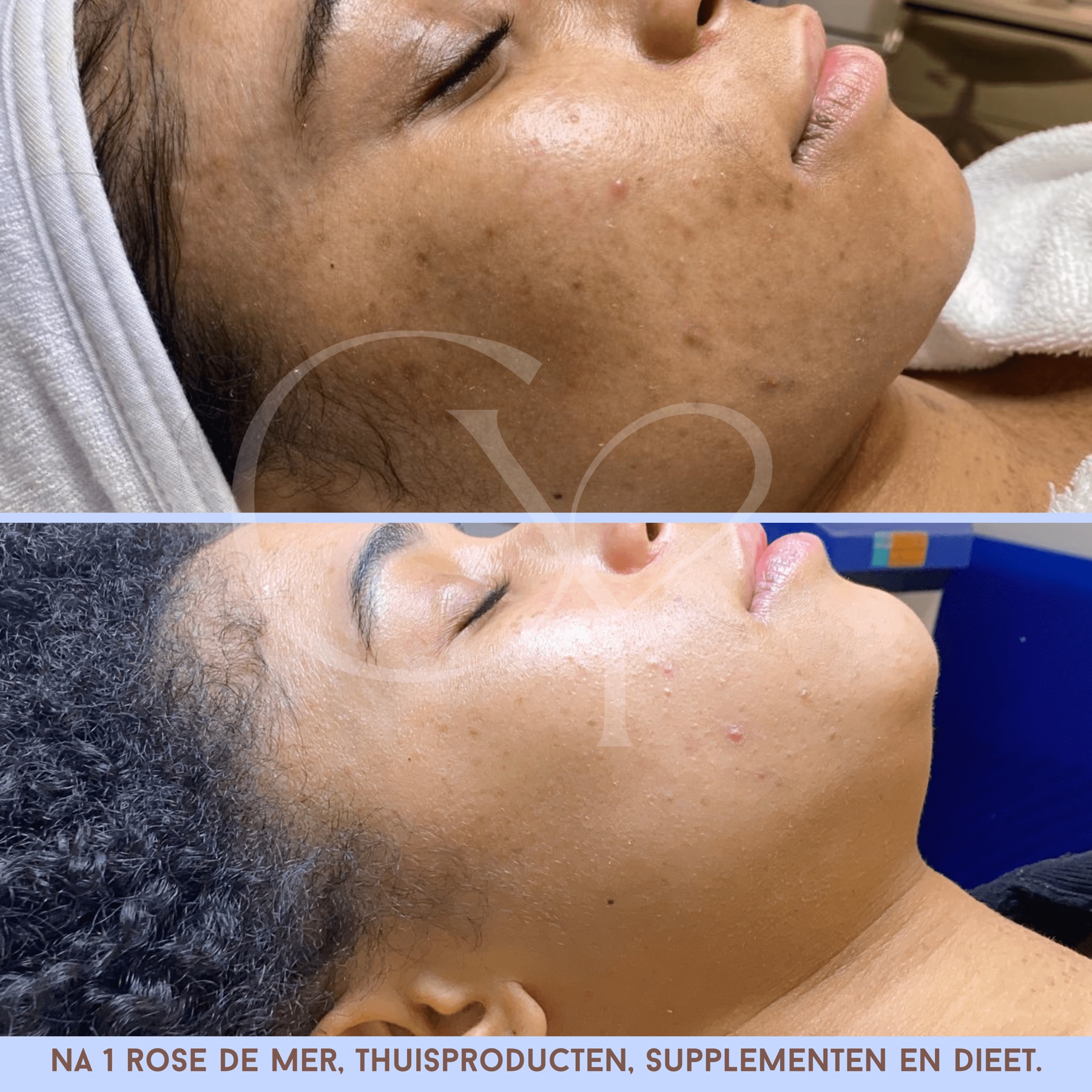 Voor en na bij Cherish Yourself: na 1 Rose de Mer behandeling, thuisproducten, supplementen en dieet