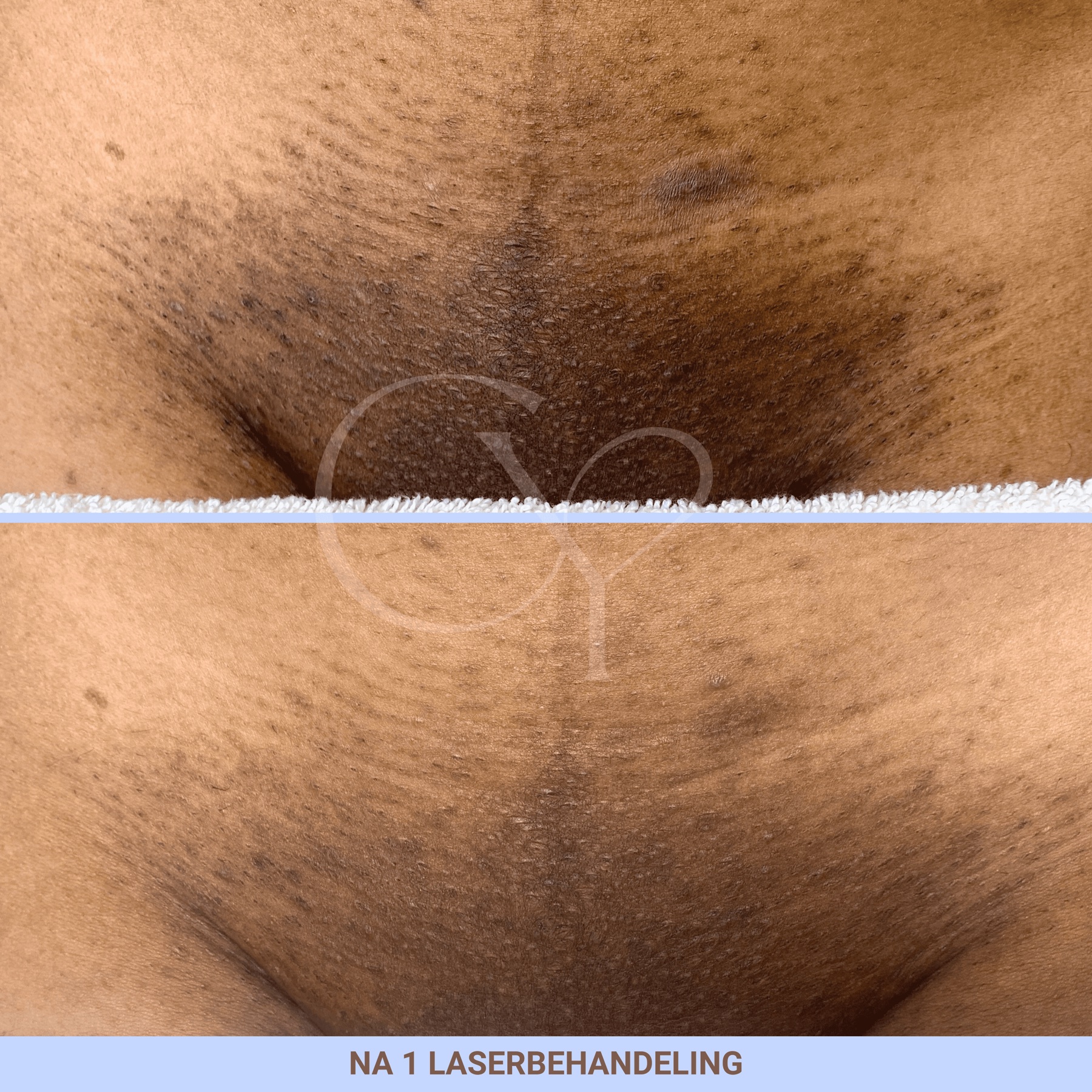 Voor en na bij Cherish Yourself: na 1 laserbehandeling