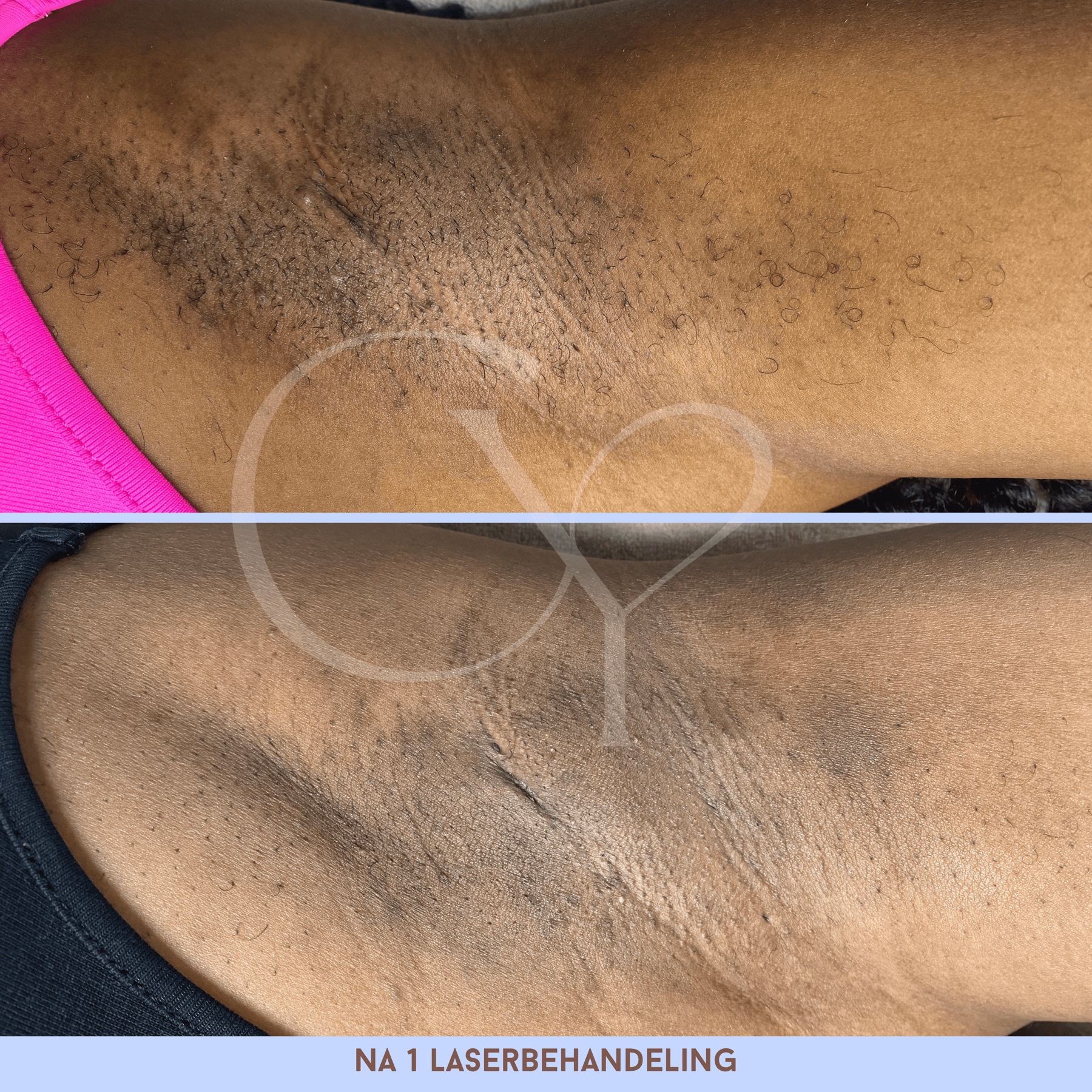 Voor en na bij Cherish Yourself: na 1 laserbehandeling