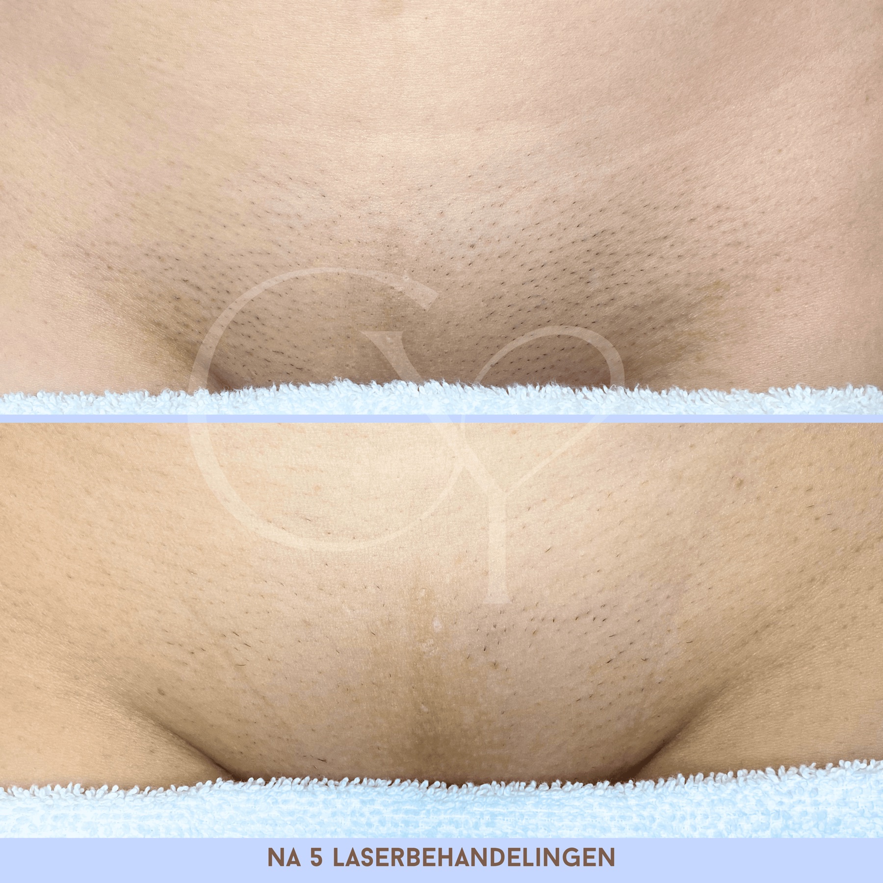 Voor en na bij Cherish Yourself: na 5 laserbehandelingen