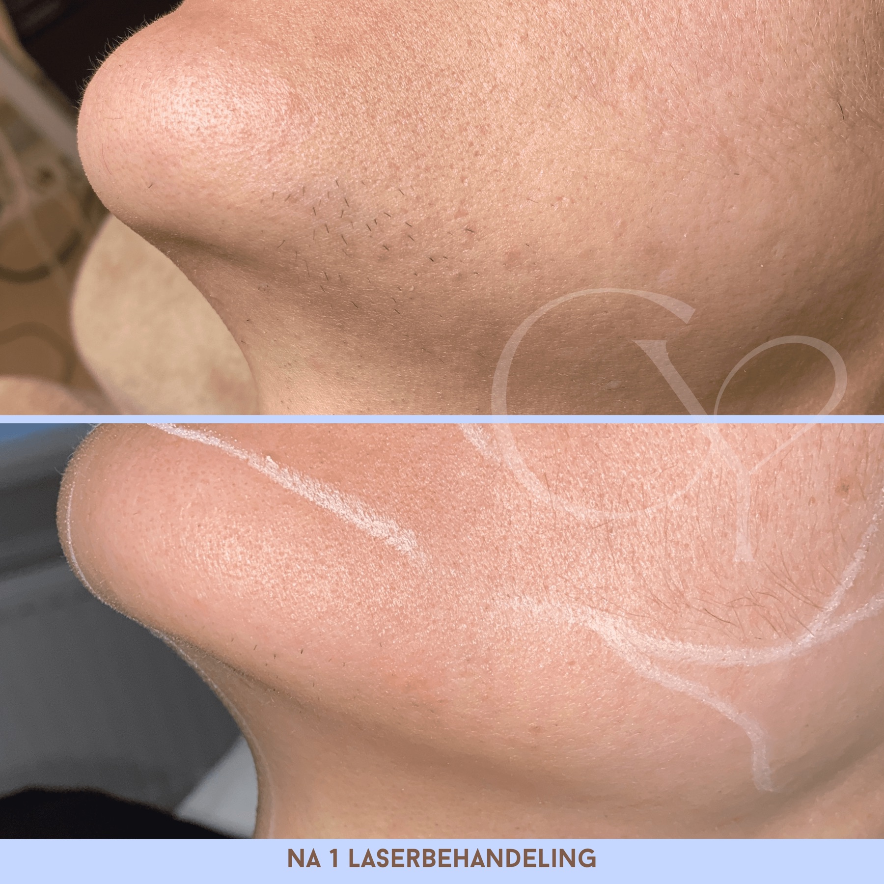 Voor en na bij Cherish Yourself: na 1 laserbehandeling