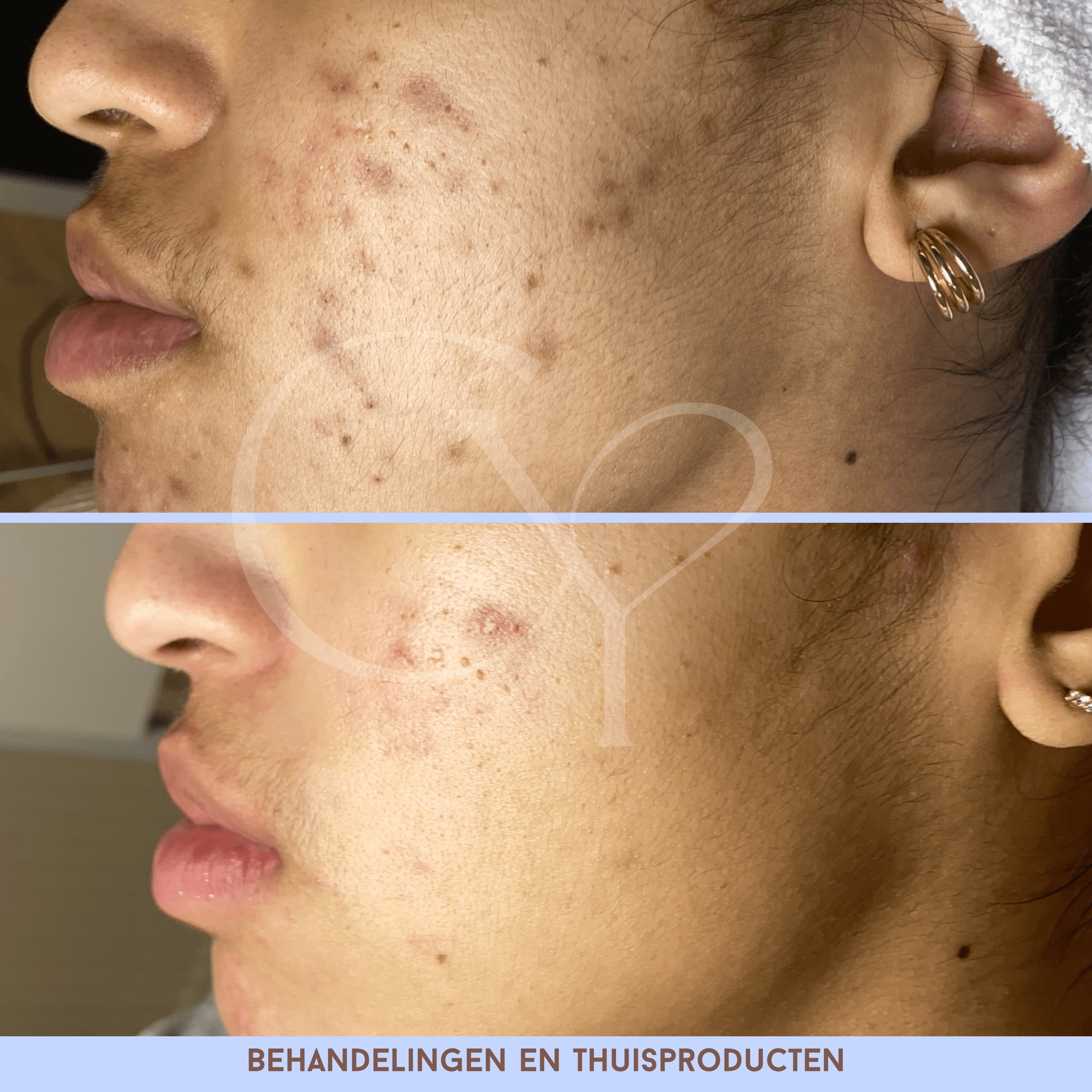 Voor en na bij Cherish Yourself: behandelingen en thuisproducten